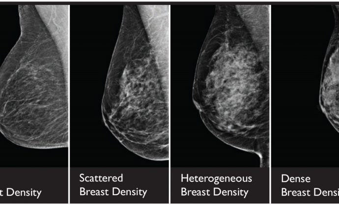 بافت متراکم سینه و سرطان پستان